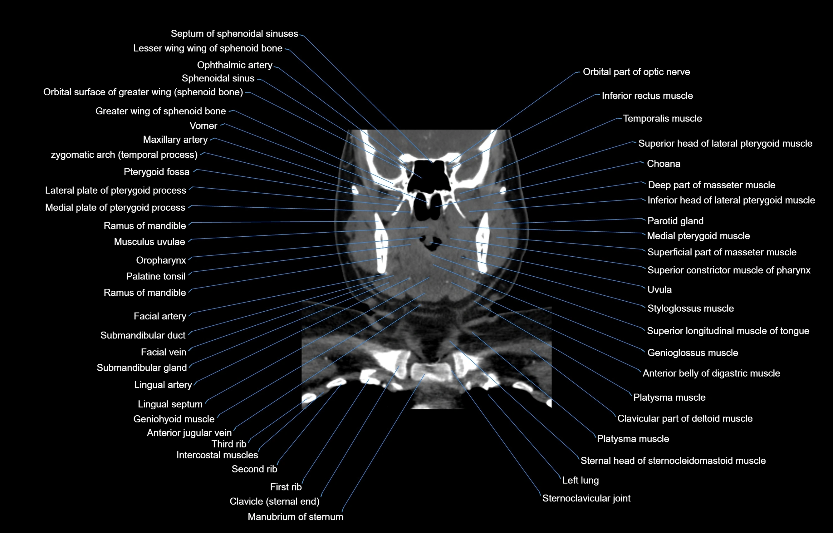 CT Neck coronal  cross sectional anatomy labelled 3D  radiology  image-00026.webp